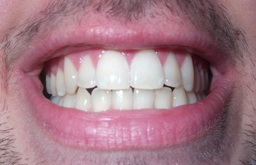 Врач Сумцова: избыток фтора ухудшает здоровье сердца