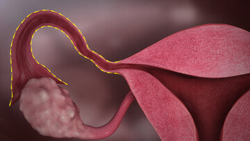 Малышева рассказала, когда кисту яичника нужно удалять