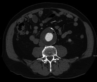 Нейрохирург Орлов: аневризма мозга вызывает проблемы с памятью