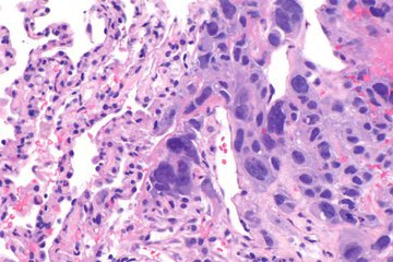 Врачи Мясников: удалять щитовидку из-за узла не обязательно