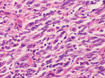 Биохимики рассказали, как предотвратить развитие устойчивости раковых клеток к химиотерапии