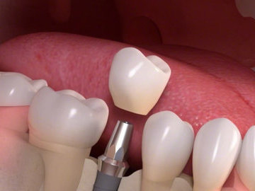 Пять мифов об имплантации зубов