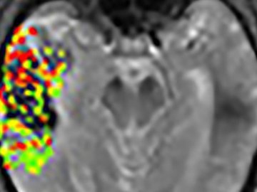 Врачами США разработан датчик, позволяющий прогнозировать инсульт