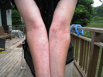 Дерматологи: кожная сыпь может быть симптомом рака легких