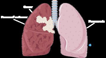 Малышева: у зумеров высокий риск бронхиальной астмы