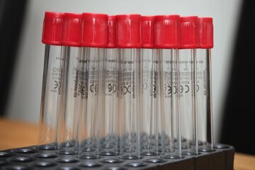 Врач Филатов: высокий билирубин указывает на долголетие