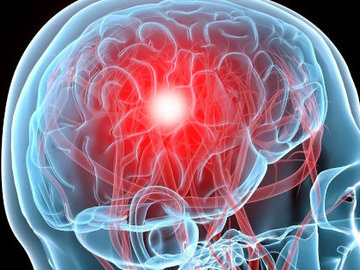 Исследователи нашли замедлители гибели клеток после инсульта