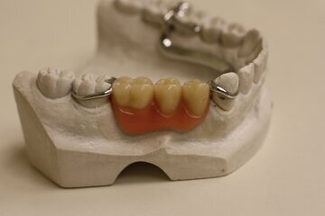 Стоматолог Минко: зубной камень доведет до кариеса