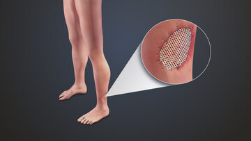 Дерматолог Антонова: лазерная эпиляция не вызывает рак