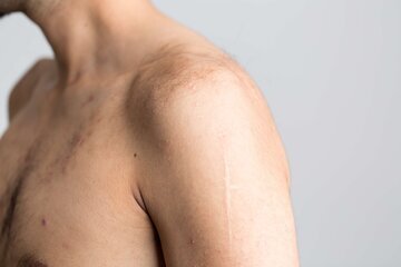 Терапевт Куденко: кожа на шее темнеет из-за диабета