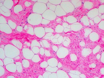 Ученые рассматривают сочетание лучевой и иммунотерапии при саркоме мягких тканей