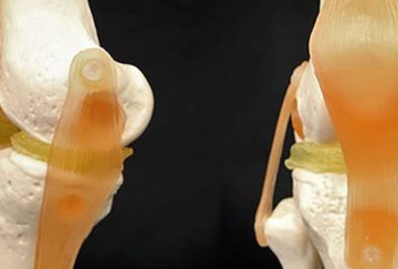 Биологи из Швейцарии создали гидрогель для восстановления менисков и хрящей