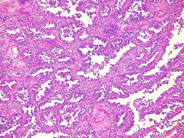 Британские ученые: сбой выработки железа может привести к псориазу