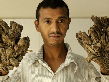 В Израиле врачи прооперировали местного "Человека-дерево"