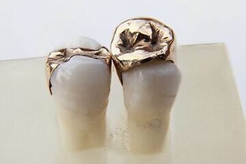 Стоматолог Альбова: пломбы нужно менять каждые 3-5 лет