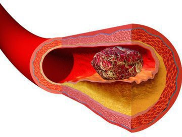 Уральские врачи разработали новый способ лечения тромбозов