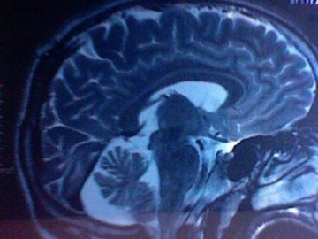 Мозговые частоты отражают прогресс в лечении депресии