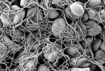 Врач Филева: при тромбозе боль в ноге будет острой