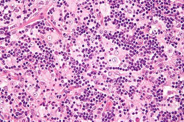 Онколог Басанов: симптомы рака кишечника малозаметны