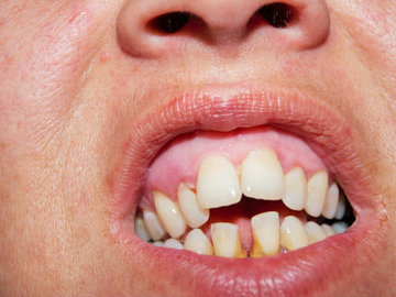 Слабоумие и плохое состояние зубов могут быть взаимосвязаны