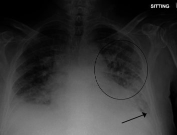 Врач Нефедов: симптомы болезни вейперов появляются через 3 месяца