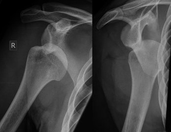 Ревматолог Глазунов: боль в костях проявляется при опухоли