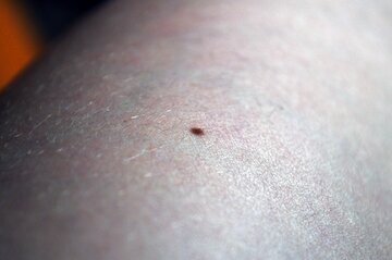 Врач Антонова: паспорт кожи снижает риск рака