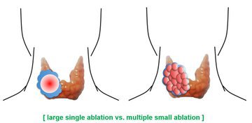 Эндокринолог Фатеева: опухоль щитовидки грозит метастазами