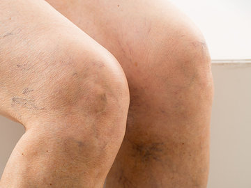 Врач-терапевт назвала причины развития варикоза