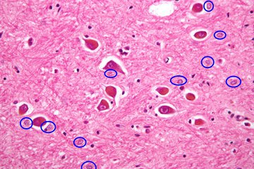 Невролог Зинчева: деменция проявляется снижением памяти и внимания