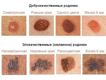 Как узнать опасную для здоровья родинку