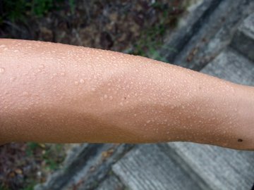 Врач Насыртдинова: повышенная потливость указывает на рак, диабет и гипертиреоз