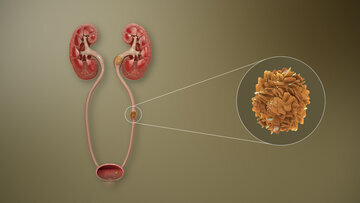 Уролог Сыркин: камни в почках грозят удалением органа