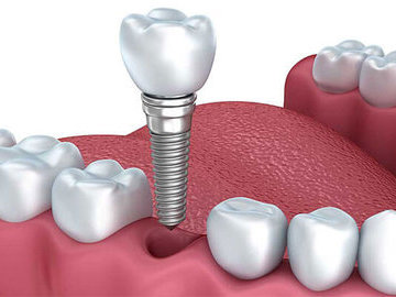 Самые главные вопросы об имплантации зубов