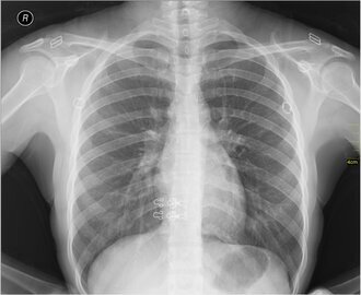 Врач Серебрякова: пневмония в отличие от ОРВИ вызывает одышку