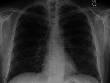 Хирург Ризаев: бронхит переносится легче пневмонии