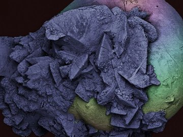 Врачи из Великого Новгорода успешно провели операцию по удалению огромной кисты