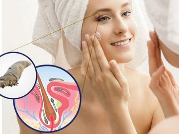 Что такое демодекоз и как с ним бороться?