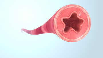 Врач Антонова: удаление сосудов может оставить рубцы