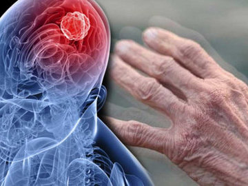 Ученые создали новый метод диагностики нейродегенеративных заболеваний