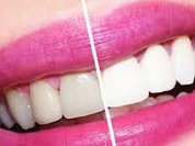 Из-за чего зубы теряют белый цвет?