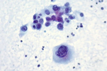 Discover Oncology: дефицит мышц ухудшает прогноз при раке груди