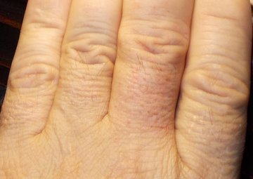 Врач Матвеева: жирный крем усилит воспаление при солнечном ожоге