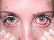 Синдром "сухого глаза" : Кто виноват, что слезы высохли? Изучение и лечение