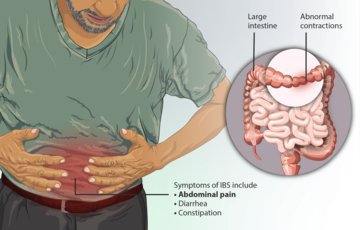 Cancer Research: ночная потливость может указывать на рак кишечника