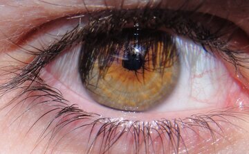 Офтальмолог Садыкова: ношение линз повышает риск конъюнктивита