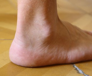 Healthline: зуд кожи на ногах может указывать на диабет