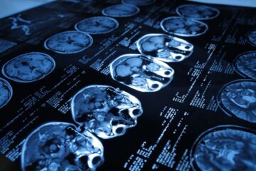 Психиатр Вилков: стресс может вызвать микроинсульт