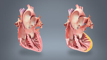CCI: стресс при депрессии грозит инсультом