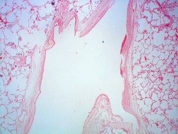 Нейрохирург Орлов: аневризмы лечат без операции